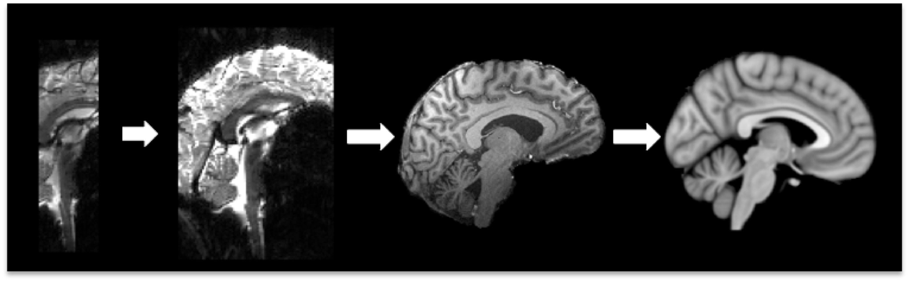 Example of Three Stage Registration